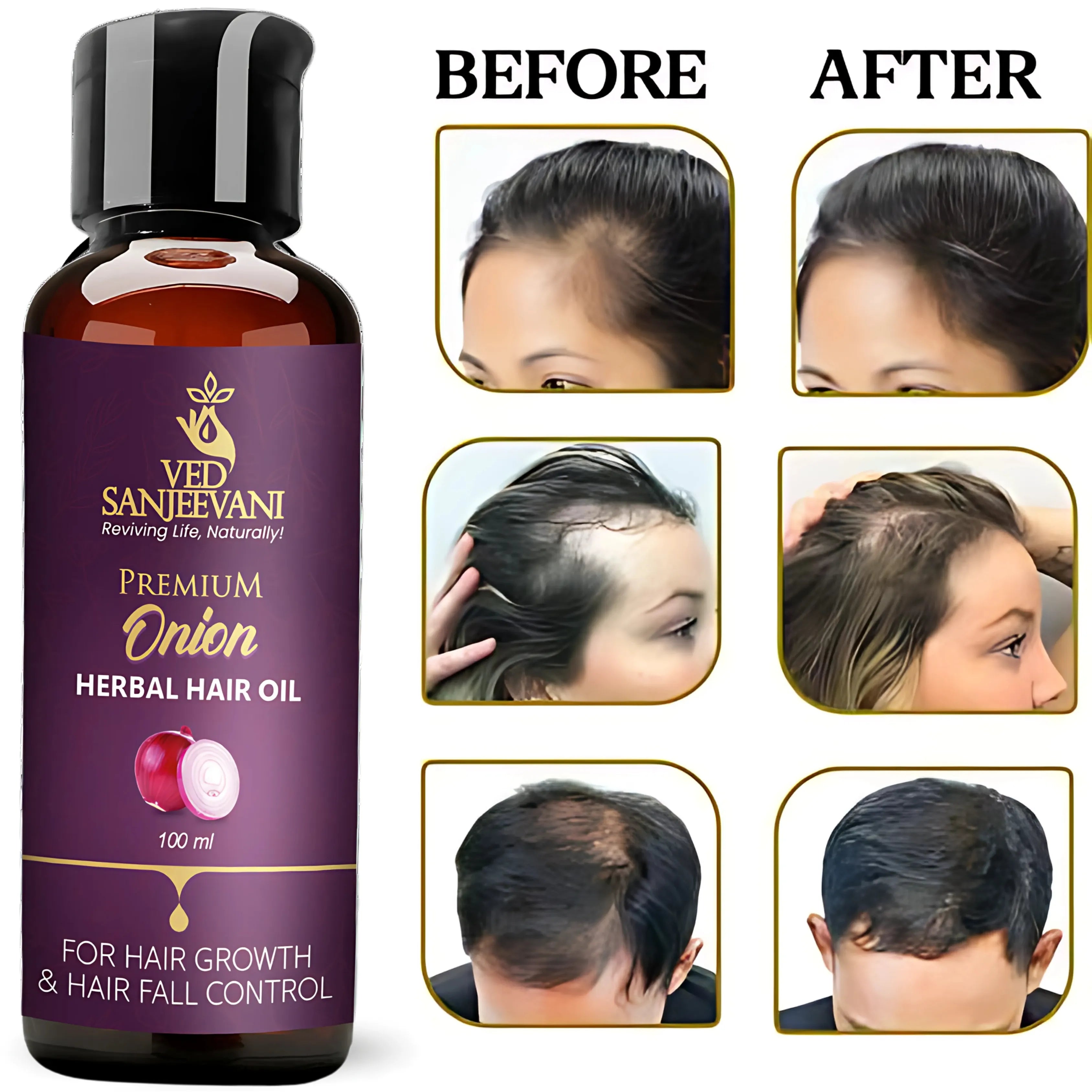 Onion Herbal Hair Oil – Ayurvedic oil for hair growth, reduced hair fall, and scalp nourishment